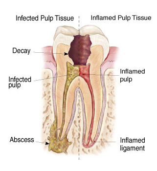 Abcessed Tooth Diagram